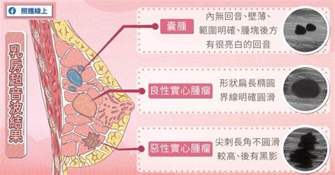 乳房有毛|乳頭邊長了毛，是什麼病？該不該拔？讓名醫一次解釋給您聽｜每